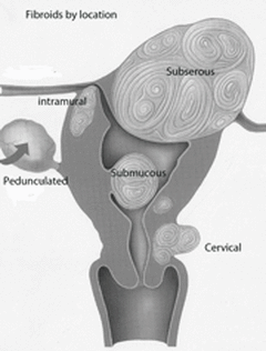 Fibroids by location
